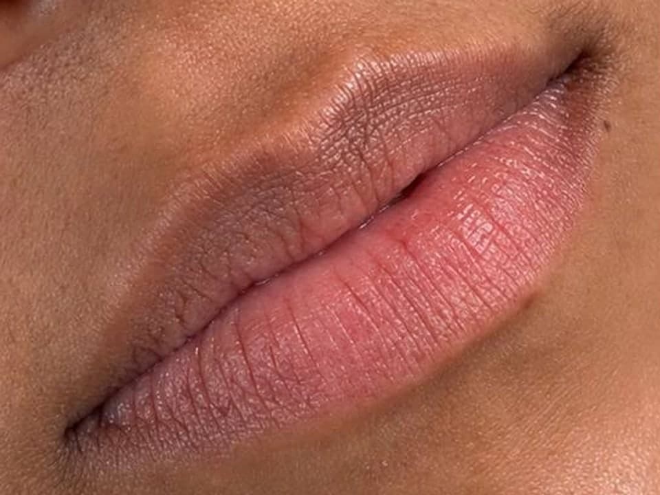 Filler — Before