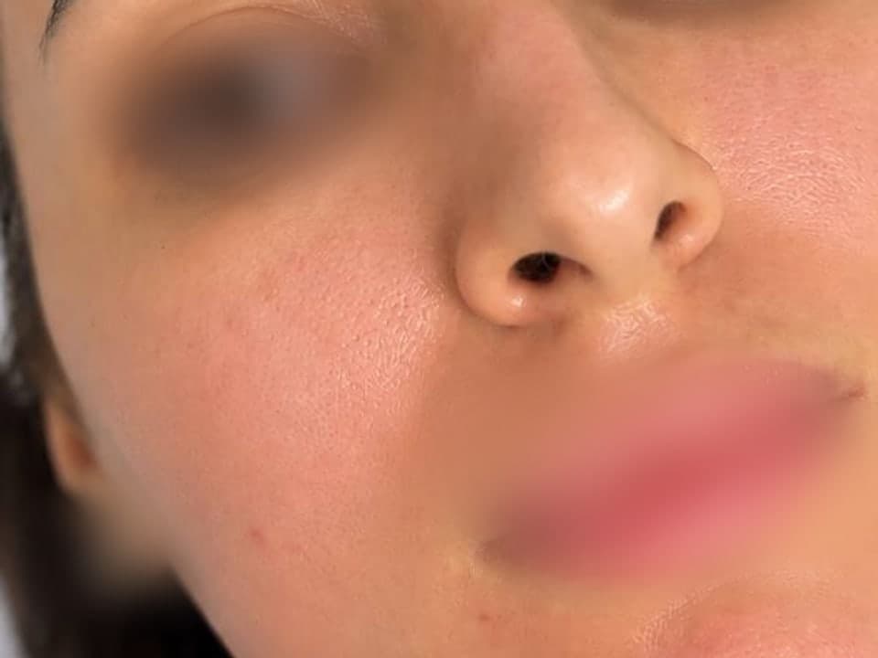 Microneedling — After