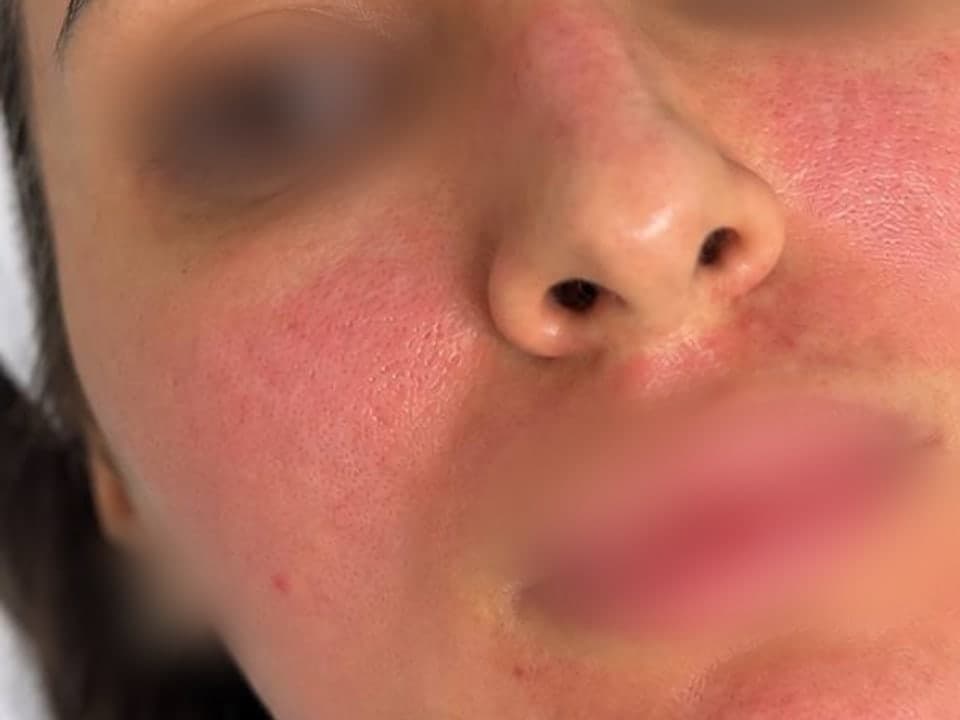 Microneedling — Before