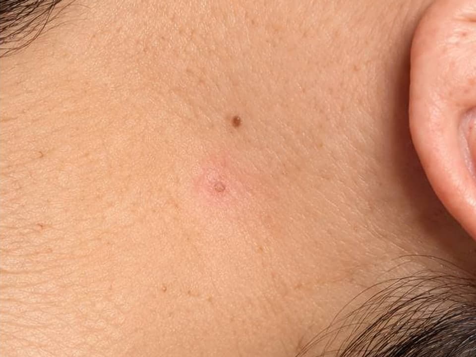 Skin Tag Removal — After