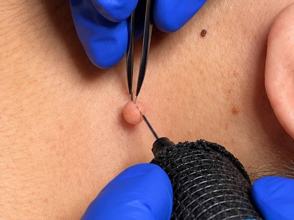 Skin Tag Removal — Before