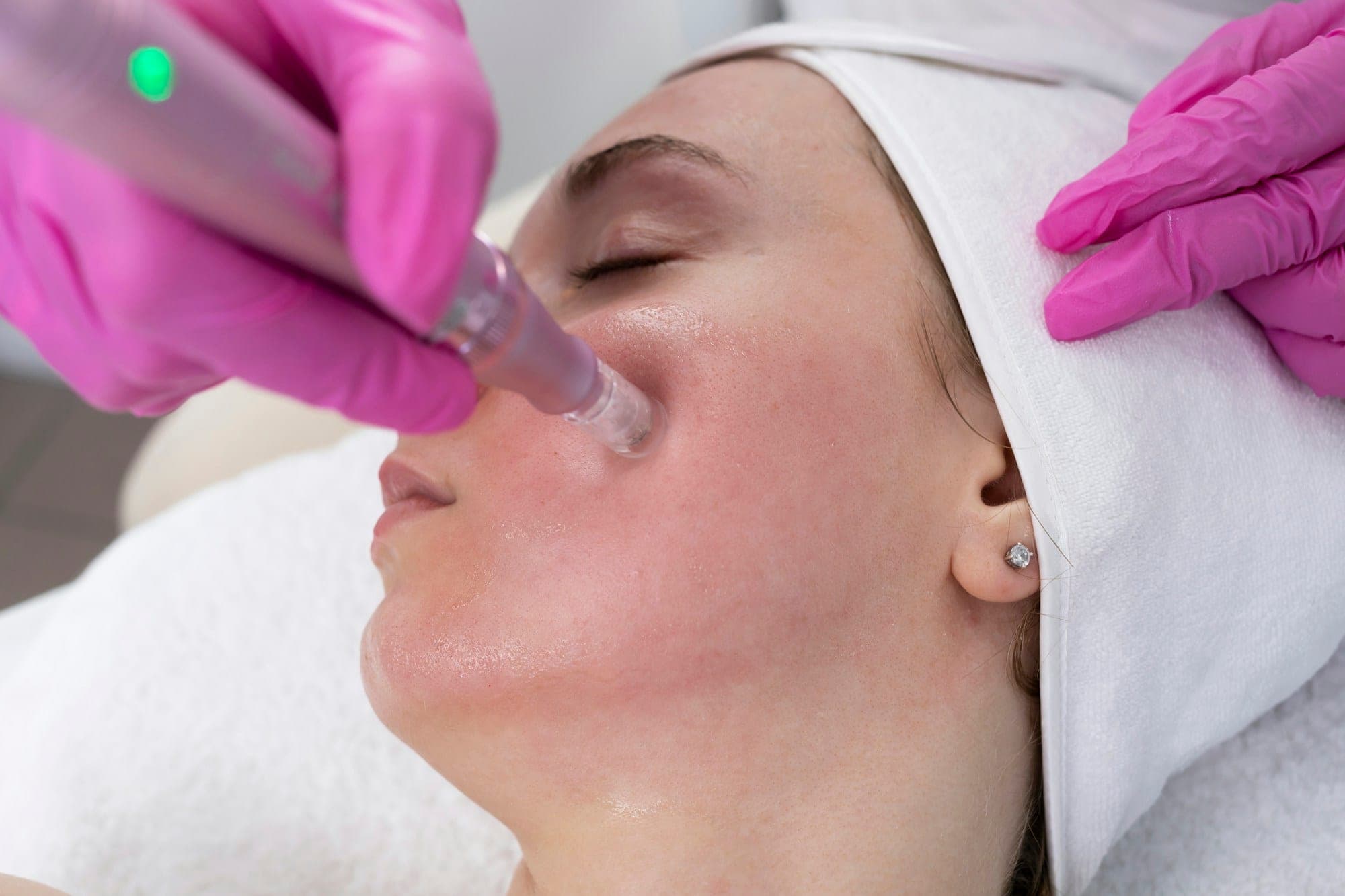 Soin de microneedling en cours