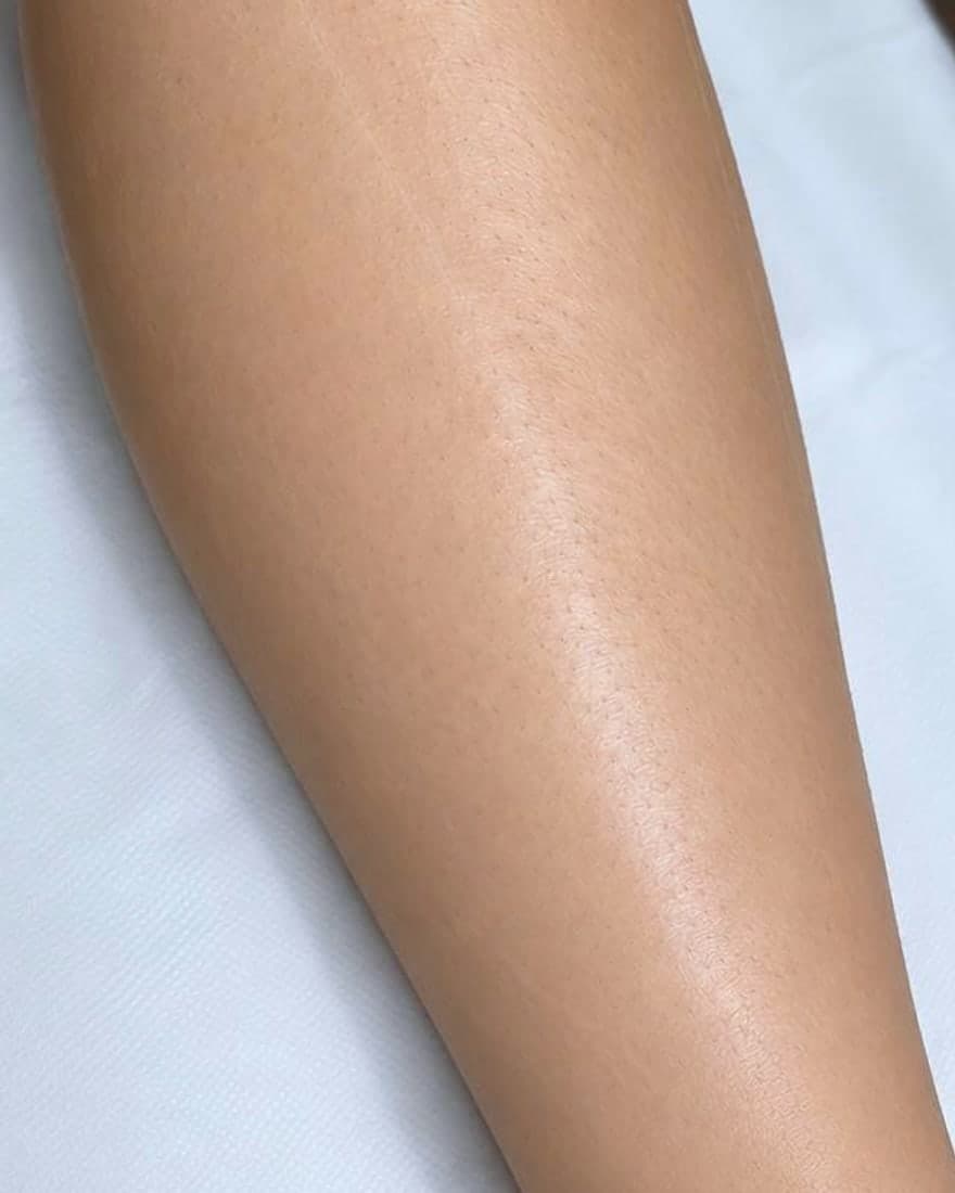 Lower leg before and after laser hair removal at CHIC — After