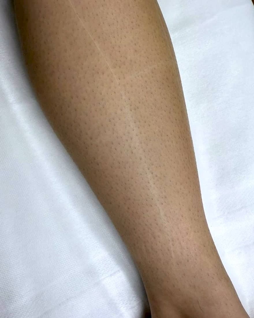 Lower leg before and after laser hair removal at CHIC — Before